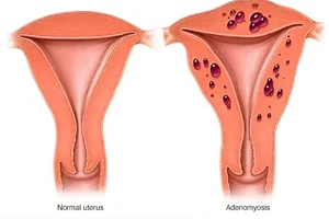Adenomyosis